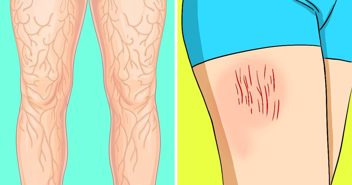 12 Blood Clot Symptoms That Might Signal a Serious Problem